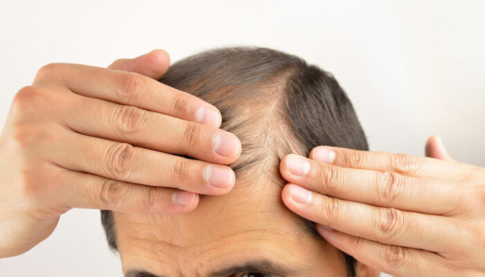 The Symptoms and Treatments for Hair Loss