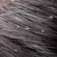 Top 5 Natural Solutions to Control Dandruff