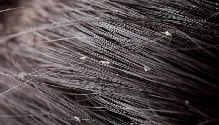 Top 5 Natural Solutions to Control Dandruff