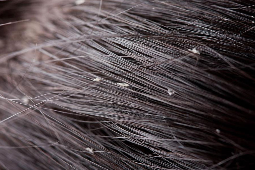 Top 5 Natural Solutions to Control Dandruff